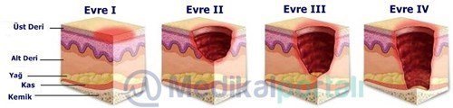 basi-yaralarinin-asamalari-ve-iyilesme-evreleri-nelerdir-ilk-ikinci-ucuncu-dorduncu-evreler-nasil-olusur-onlenir-risk-faktorleri-nelerdir