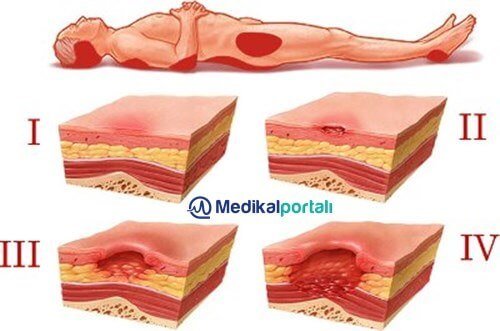 yatak-basi-yarasi-sorunu-problemi-nedir-neden-olusur-tedavi-yontemleri-evreleri-asamalarıi-cozum-yollari-nelerdir